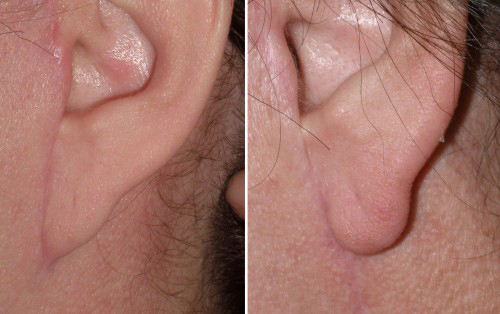 Pixie Ear Lobe corrected by Dr Niamtu