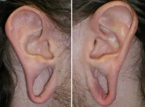 gauged earlobe repair