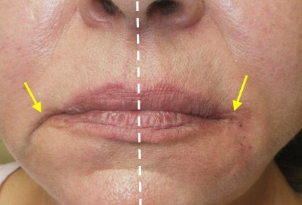 Before and after lip filler treatment