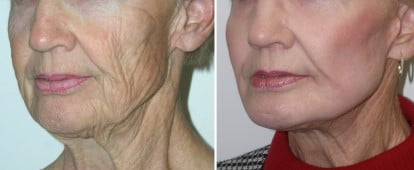 Laser resurfacing treatment and facelift