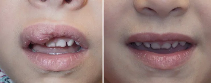 hemangioma-treated-by-surgery