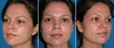 Face Peels in Richmond