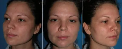 Face Peels in Richmond