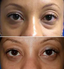 lower lid fat bags may be hereditary