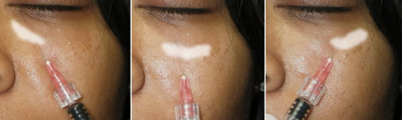 upper face filler in richmond