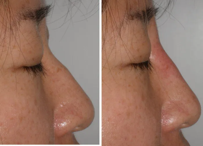 patient below had injectible filler to reduce nasal hump