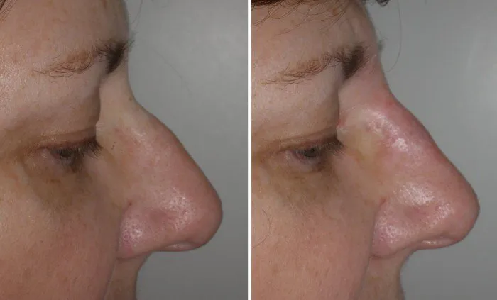 injectable filler to reduce nasal hump case 2
