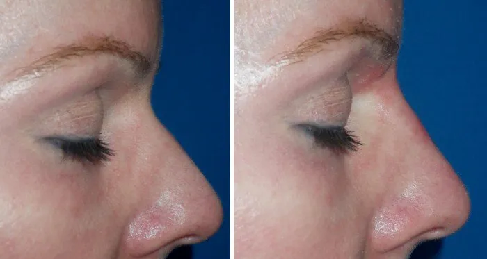 injectable-filler-for-nasal-hump-case-4