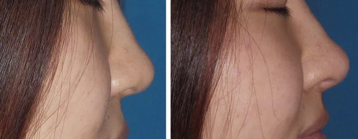 injectable-filler-for-nasal-tip-case-1a