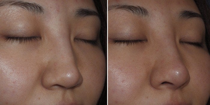 injectable-filler-for-nasal-tip-case-1b