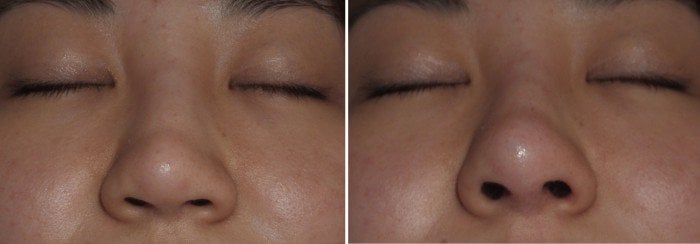 injectable-filler-for-nasal-tip-case-1c