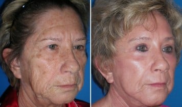 Laser resurfacing treatment
