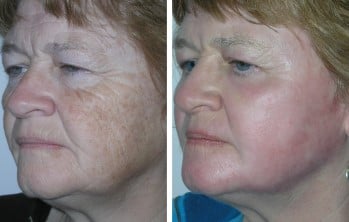 Laser resurfacing treatment