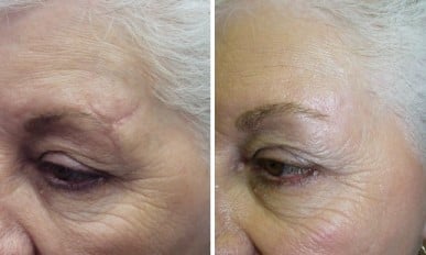 Laser resurfacing treatment to improve scarring