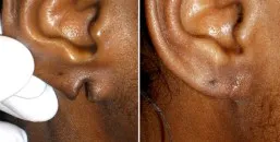 torn earlobe repair