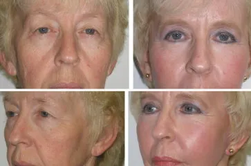 examples of before and after cheek implants and lower eyelid surgery