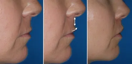 Lip Lift in Richmond, VA