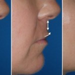 Lip Lift in Richmond, VA