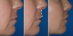 Lip Lift in Richmond, VA