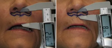 Lip Lift in Richmond, VA