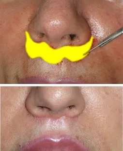Lip Lift in Richmond