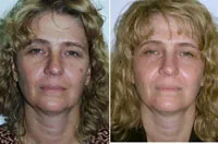 CO2 lite laser treatment