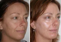 CO2 lite laser treatment