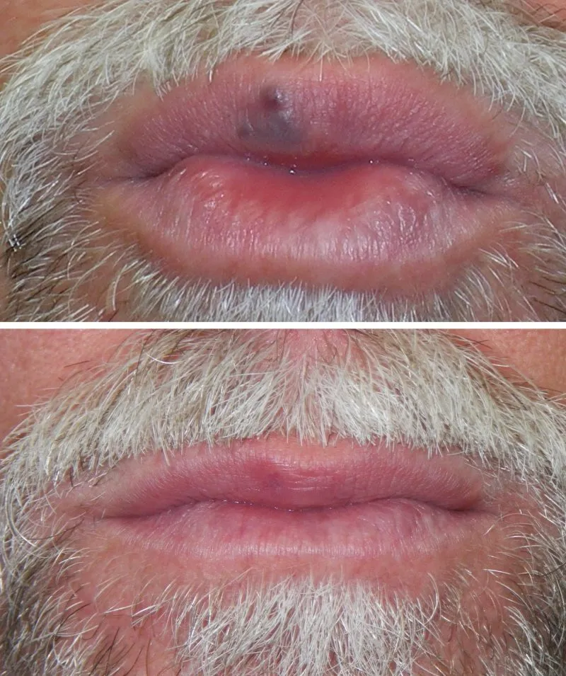 mole removal