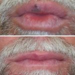 mole removal