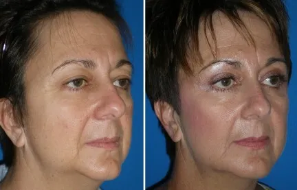 lower face fillers in richmond