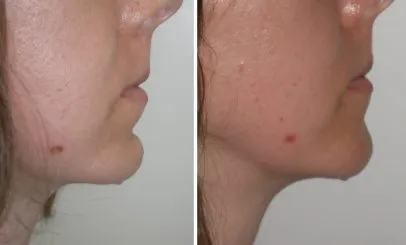 lower face fillers in richmond