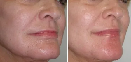 lower face fillers in richmond