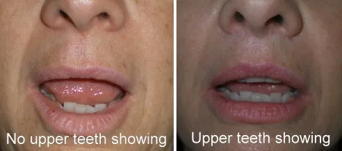 Lip Lift in Richmond, VA