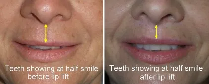 Lip Lift in Richmond, VA