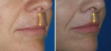 Lip Lift in Richmond, VA