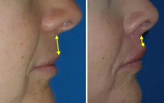 Lip Lift in Richmond, VA