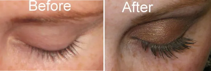 Melissa Chase photos after 2 years with Latisse eyelash treatment