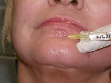 lower face fillers in richmond