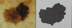 a = Asymmetry (one half of the mole unlike the other half)