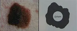 d = Diameter larger than a pencil eraser. (this general rule is used to estimate size)