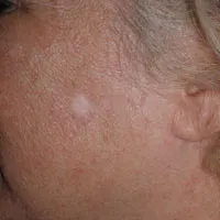 Mole Removal, Richmond VA
