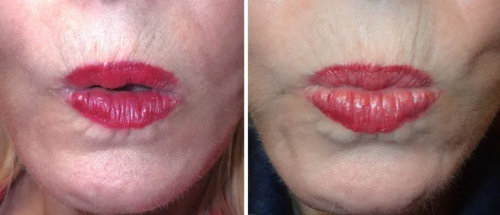 temporary nerve damage example and full return of normal movement 8 weeks after the facelift