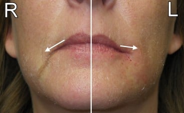 Injectable fillers placed in the corners of the mouth can turn a frown upside down