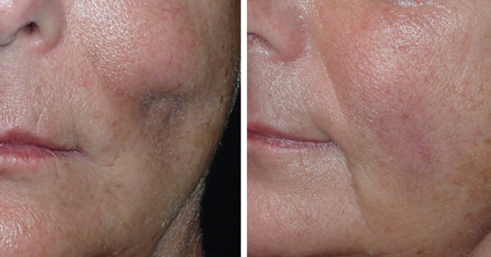 facial scar surgery in richmond