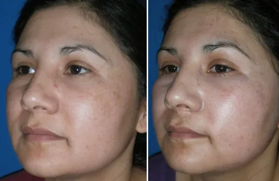 Face Peels in Richmond, VA