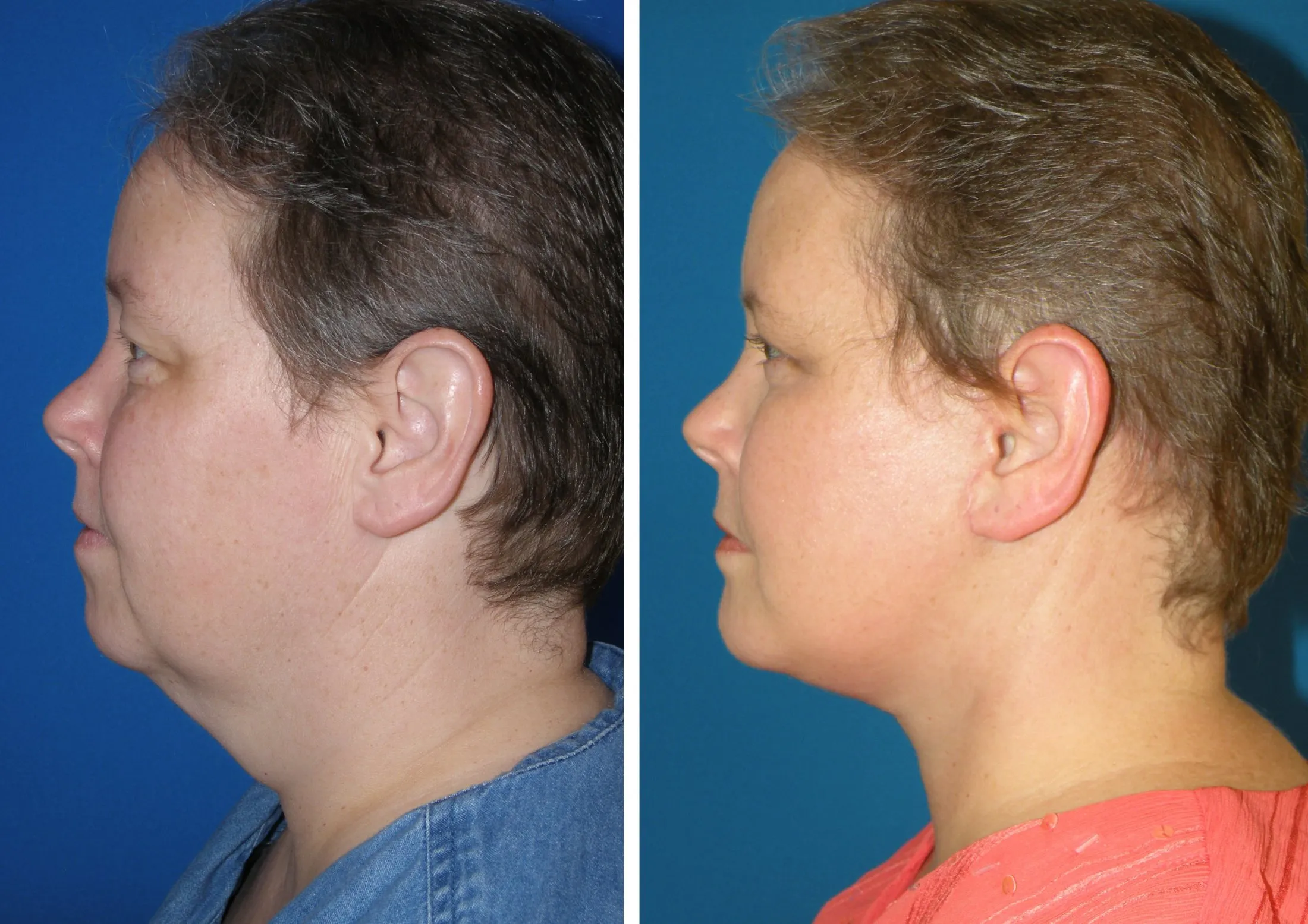 Obtain A Chiseled Look - Custom Jaw and Chin Implants — Plastic