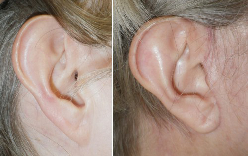 Pixie Ear Lobe corrected by Dr Niamtu