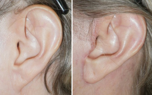 Pixie Ear Lobe corrected by Dr Niamtu