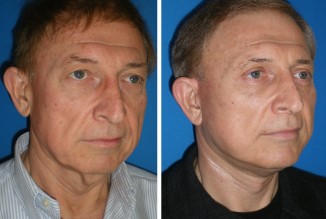 Video Testimonial for Richmond, VA Cosmetic Facial Surgery
