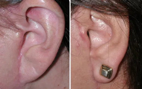 Pixie Ear Lobe repaired by Dr Niamtu
